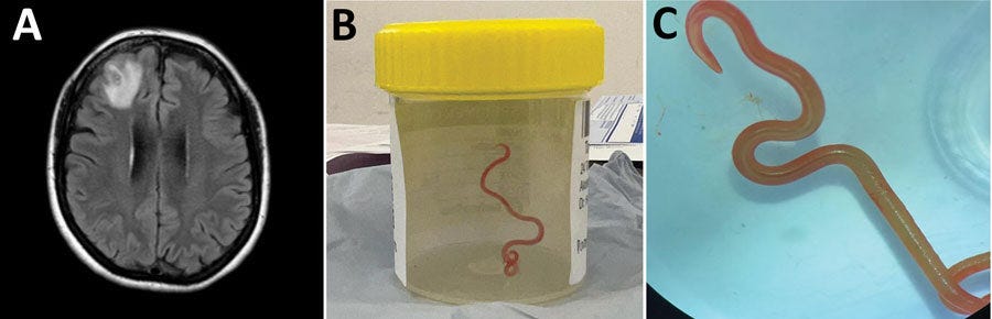 Doctors find live worm in patient's brain